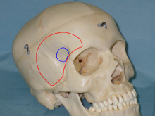 Pterional Keyhole for aneurysms